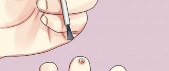 Препараты для удаления папиллом и ВПЧ: обзор средств