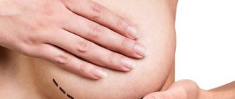 Подтяжка груди (мастопексия) – разновидность пластической операции для улучшения формы и высоты молочных желез