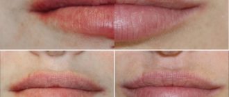 Липофилинг. Отзывы клиентов