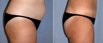 Липомоделирование тела: техника и результаты электронного высокочастотного липомоделирования