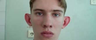 Как устранить лопоухость и какие методы для этого существуют