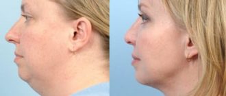 Липосакция подбородка: преимущества и цена лазерной липоксации + фото факты