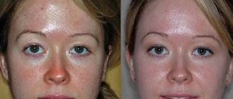 Микродермабразия лица от фаберлик и мери кей в домашних условиях + фото