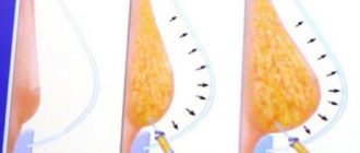 Коррекция размеров груди при помощи липофилинга