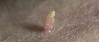 Нитевидные папилломы: лечение и профилактика болезни