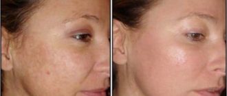 Лазерное омоложение лица: эффект от процедуры и есть ли противопоказания