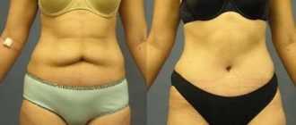 Абдоминопластика: виды хирургической коррекции живота + фото до и после операции