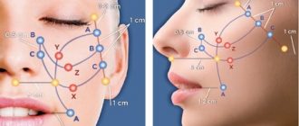 Растворимые нити SilhouetteSoft – 2 года без морщин и заломов кожи