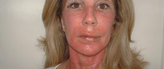 Возможны ли осложнения после пилинга?