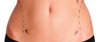 Возможные осложнения после липосакции – отзывы