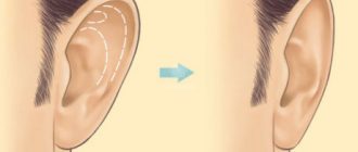 Пластика ушных раковин