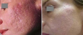 Лазерный пилинг лица: суть процедуры и правила ухода за кожей до и после