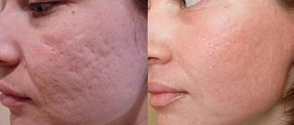 Рубцы от прыщей на лице: как убрать их безвозвратно
