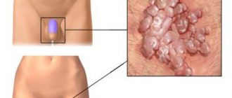 Папилломы в паху: причины и способы лечения