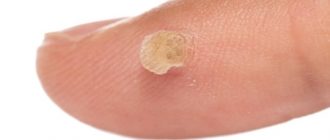 Отчего появляются папилломы на теле: причины и как защитится от ВПЧ