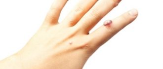 Опасны ли папилломы: чем грозит ВПЧ и как его лечить