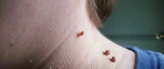 На теле много паппилом: что делать и как лечить