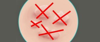 Можно ли удалять папилломы, какими способами и методами