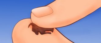 Папиллома потемнела: в чем опасность, как удалить и лечить