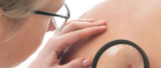 Как выглядит папилломы и какие признаки ВПЧ