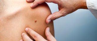 Удаление папиллом лазером: противопоказания, рекомендации метода