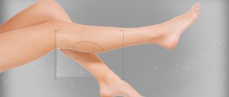 Пластика для коррекции голеней