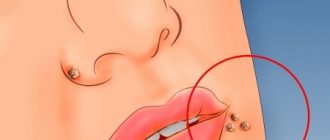 Плоские папилломы: причины появления и способы лечения