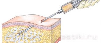 Липофилинг губ и ягодиц: особенности и стоимость процедуры