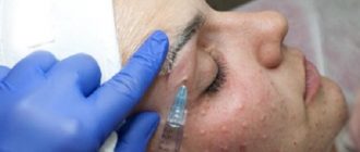 Папулы после биоревитализации и мезотерапии: стоит ли беспокоиться?