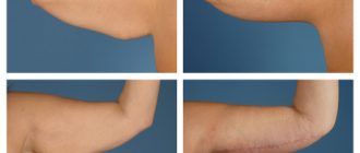 Брахиопластика, подтяжка кожи рук. Отзывы