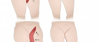 Подтяжка бедер. Отзывы