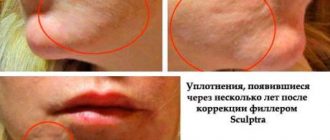 Чем опасны шишки и уплотнения после филлеров и как их убрать