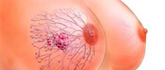 Гипертрофия молочных желез: разновидности и методы лечения