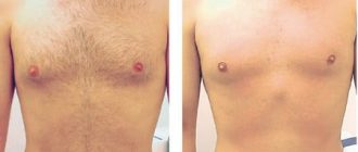 Лазерная эпиляция: как проходит процедура и вредна ли она + видео