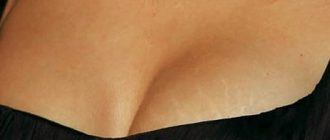 Растяжки на груди: можно ли от них избавиться