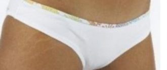 Народные средства от растяжек: 100% эффективности при своевременном использовании