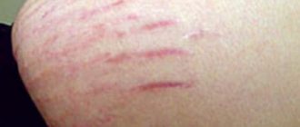 Как убрать растяжки и возможно ли полное избавление от стрий