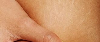 Стрии у подростков: почему образуются растяжки на спине у подростков + профилактика и лечение