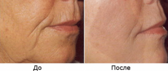 Rf лифтинг: безоперационное омоложение при помощи радиоволн дает мгновенный результат