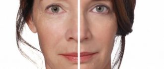 Радиесс – гель для контурной пластики с оптимальными свойствами