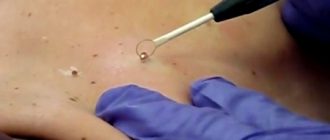 Радиоволновое удаление папиллом: достоинства и противопоказания