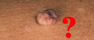 Отличия родинки от папилломы: отличительные признаки и причины появления