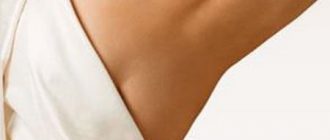 Стрии: удаление и лечение стрий на животе и спине у мужчин и на ягодицах и груди у женщин + фото