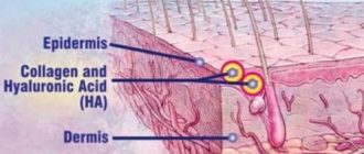 Ботокс или гиалуроновая кислота: сходство и различие препаратов