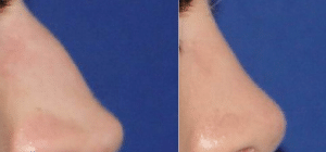 Септопластика носовой перегородки: лечение, последствия, цена