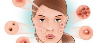 Виды прыщей: угри