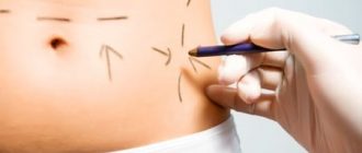 Безоперационная липосакция – ультразвуковая кавитация живота: цены и результативность