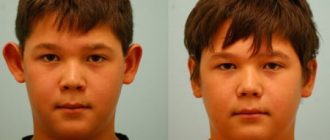 Пластика ушей: сколько стоит операция и каковы ее последствия + отзывы