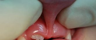 Пластика уздечки губы: кому показана и какими способами лучше делать