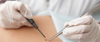 Как удалить папилломы прижиганием: способы и их особенности